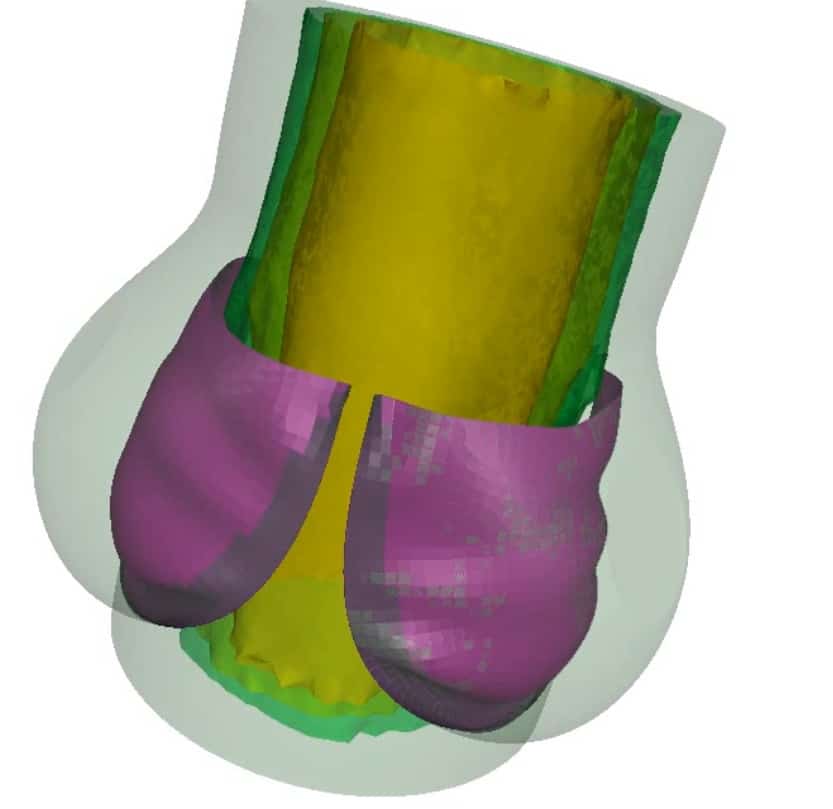 heart valve Ansys ls-dyna simulation design finite element fea